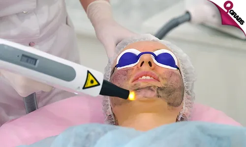 Carbon Laser Treatment!